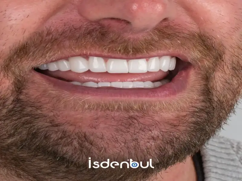 Hollywood Smile Design